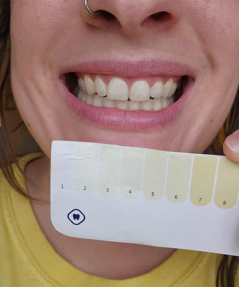 Customer-reported teeth whitening result