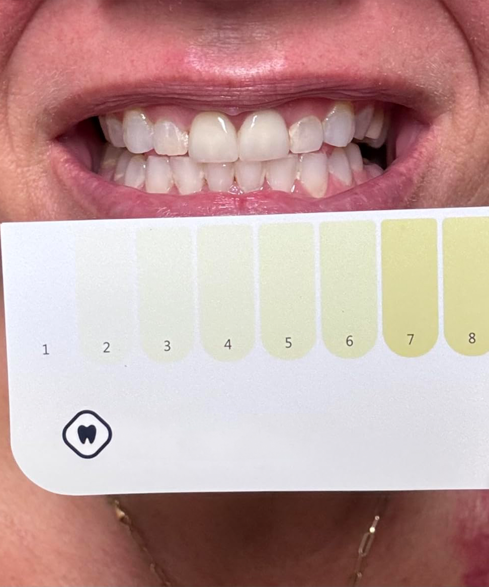 Customer-reported teeth whitening result