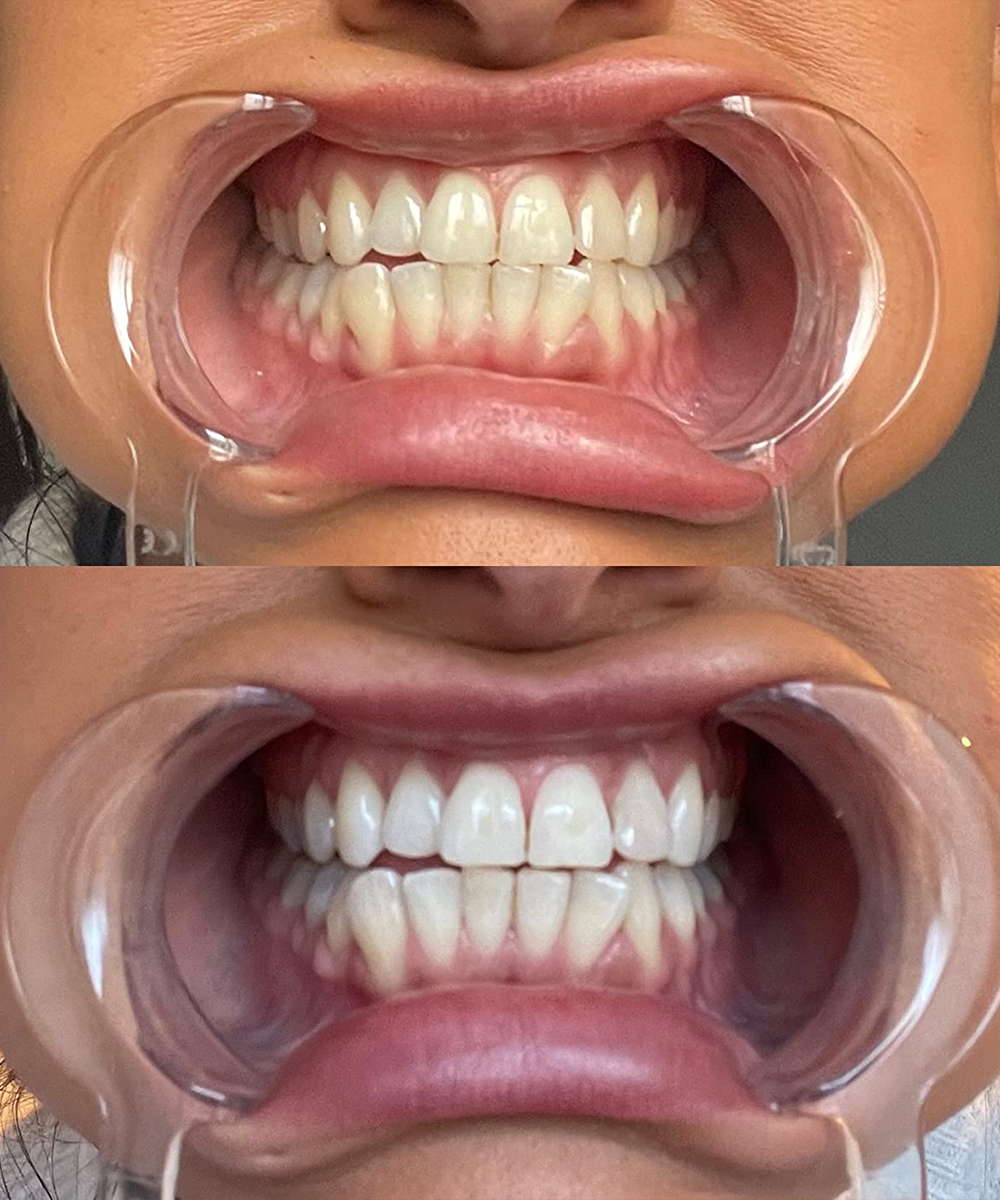 Customer-reported teeth whitening result