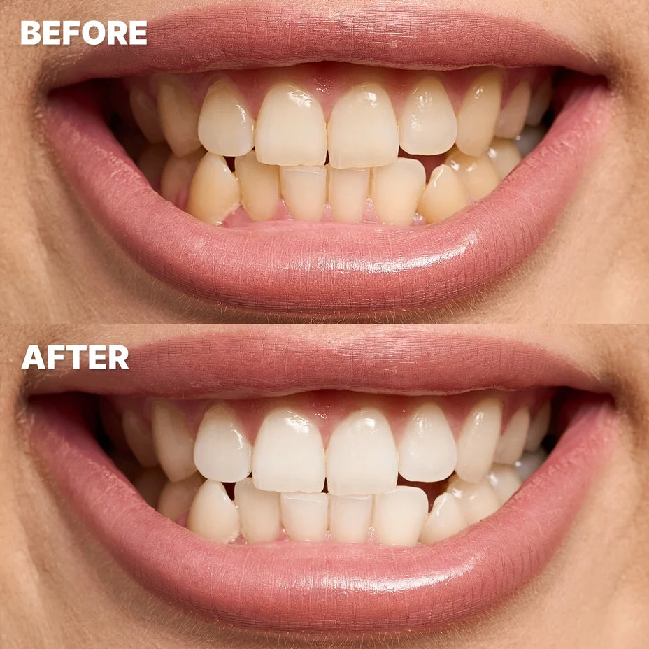 DR.DENT before and after whitening result
